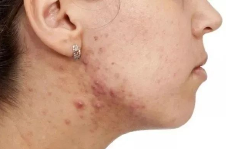 Australian tea tree essential oil shower gel removes mites, removes acne, and keeps skin healthy(pic7) image.png