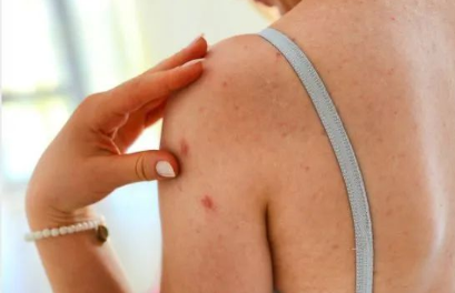 Australian tea tree essential oil shower gel removes mites, removes acne, and keeps skin healthy(pic11) image.png