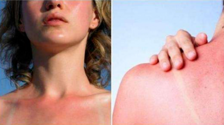 How to provide first aid after skin exposure? Teach you a trick KO Annoying UV rays!(pic2) image.png